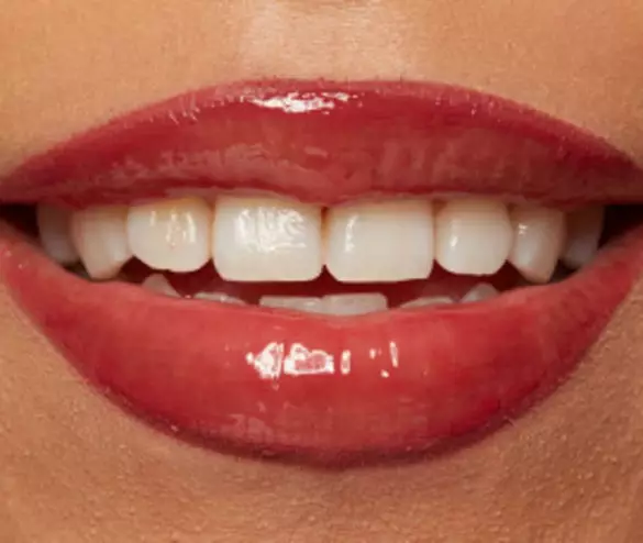 Close-up of a smiling mouth with glossy red lips and bright white teeth against a neutral background.